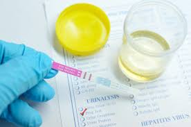 Urine pregnancy test